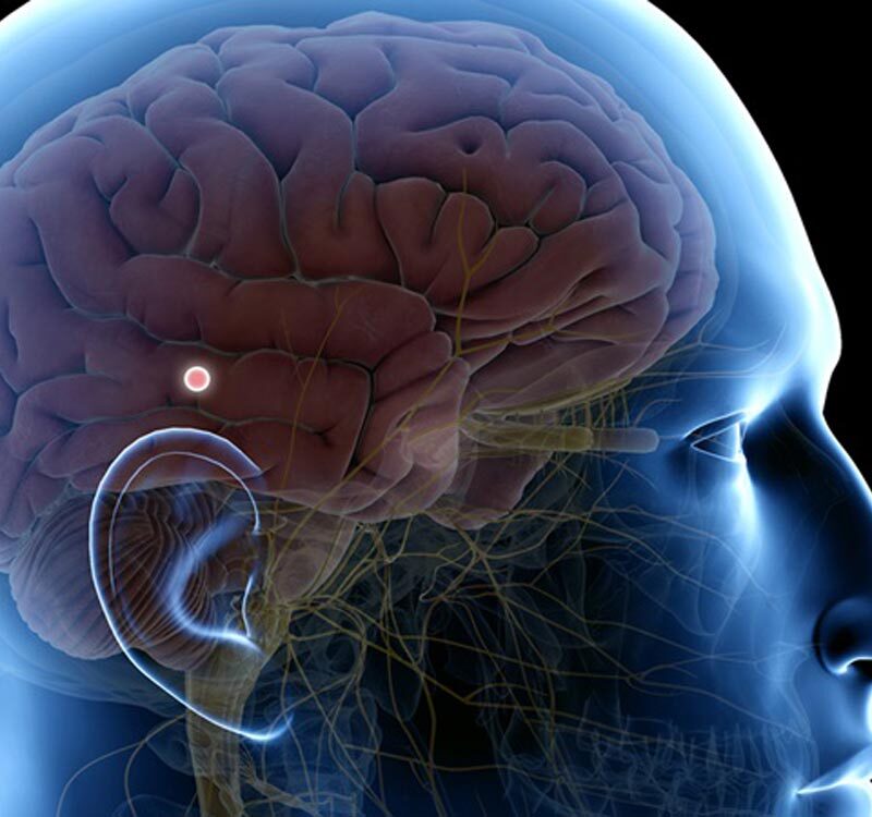 La calcificacion de la GLANDULA PINEAL